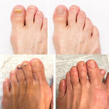 Lade das Bild in den Galerie-Viewer, PureNail - patentierte Nagelpilz-Therapie - für gesunde Nägel innerhalb von 4 Wochen